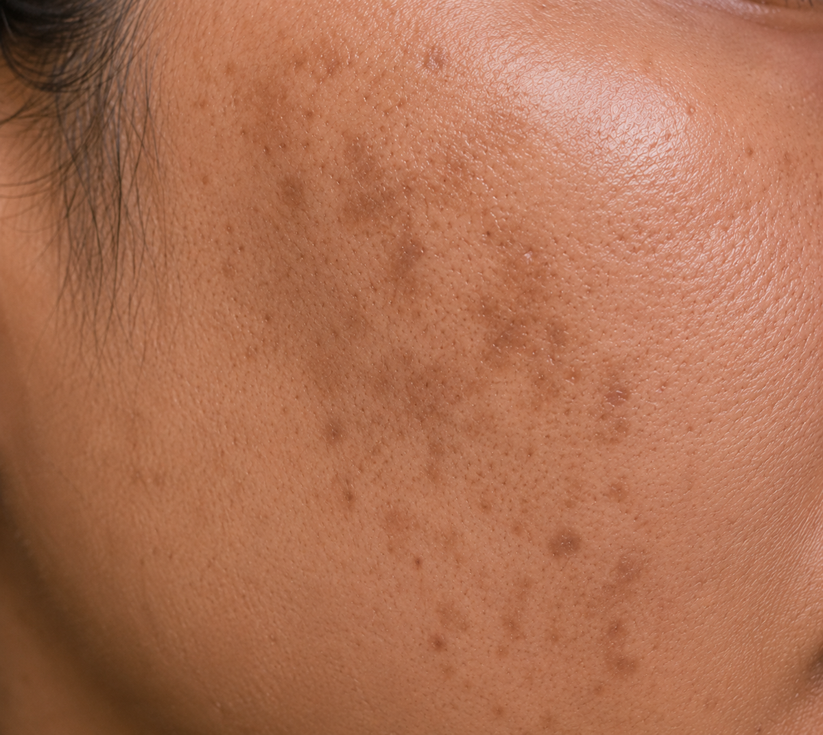 Before using Cosmelan Plus Cream