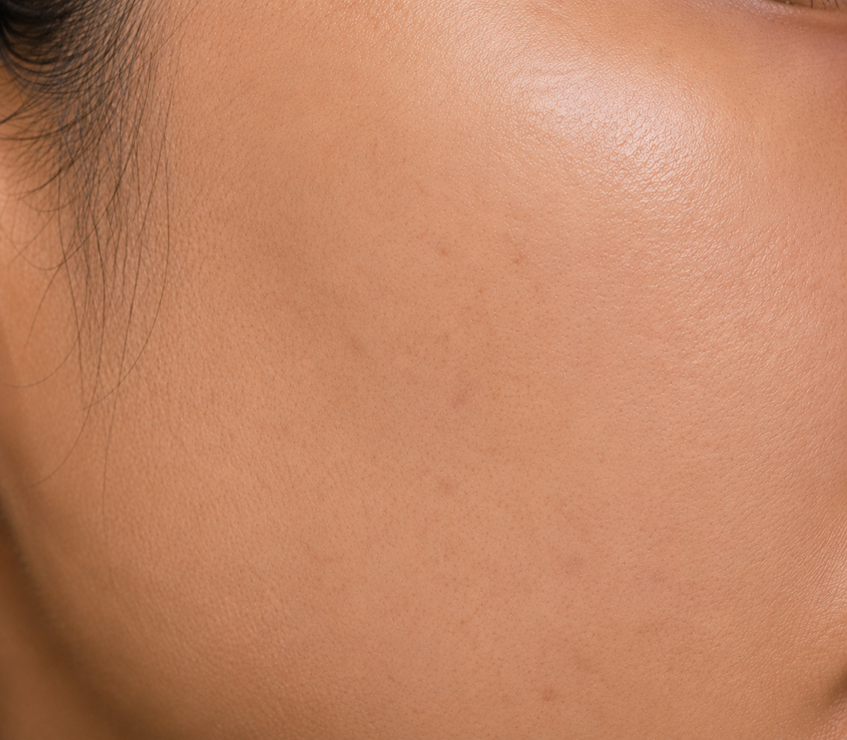 After using Cosmelan Plus Cream