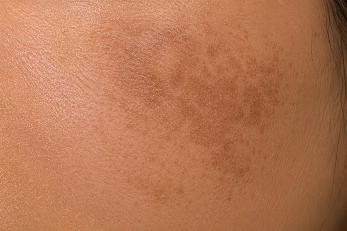 Before using Cosmelan Cream